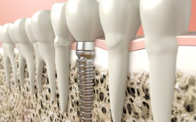 Dental Implants in Eden Prairie Will Fix Your Smile
